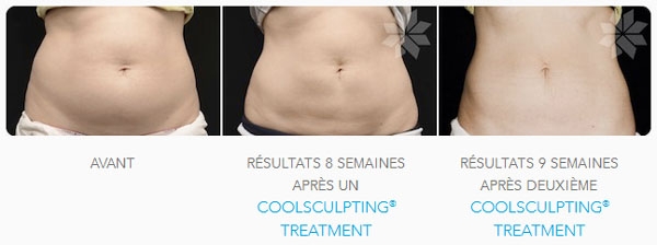 Coolsculpting avant / après