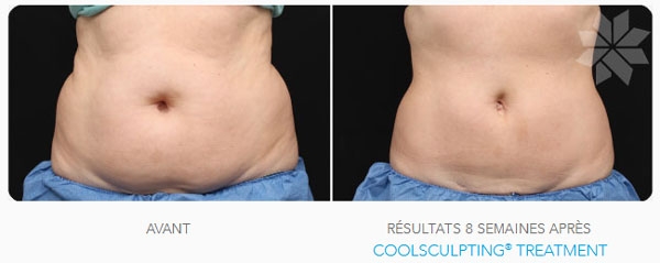 Traitement par Coolsculpting